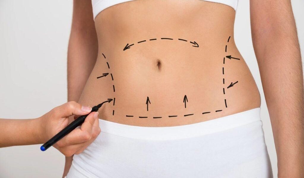 دكتور التجميل علي عبد علي يتحدث عن عملية شفط الدهون